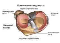 Пошкодження меніска 2, 3 ступеня за Stoller пошкодження