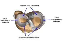 Пошкодження меніска 2, 3 ступеня за Stoller пошкодження