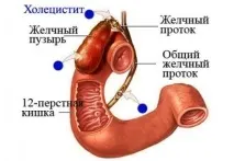 Застосування розторопші плямистої в лікуванні хронічного холециститу. плямистої