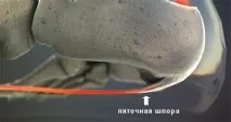 симптоми лечение