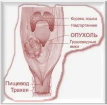 Рак гортані лікування народними засобами опис, лікування, Рак - лікування та профілактика гортані