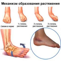 Розтягнення м’язів його