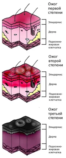 изгаряния изгаряния