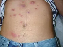 Сифілітична висипка фото у чоловіків як виглядає, відгуки висипка