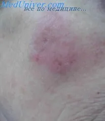 гъбичната микоза псевдолимфома