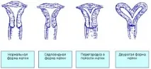 причини образуване