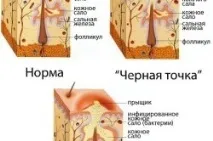 средства акне