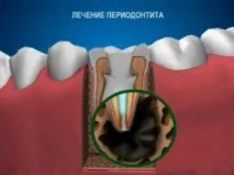 лікування