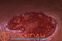 Трофічні виразки на ногах фото та початкова стадія хвороби, Хвороби судин та способи їх лікування фото