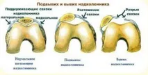 дислокация дислокация
