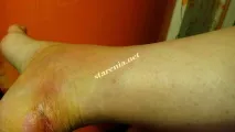 Волога мозоль, натерта взуттям волога