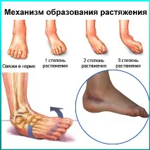 постигане изкълчено