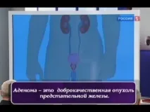 Все про підступний простатит і аденом простати простатит