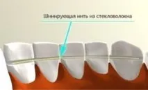 Адгезивне протезування (шинування) фронтальних, передніх, нижніх та жувальних зубів у клініці адгезивне