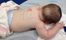 Алергія на солодке у дітей симптоми та лікування солодке