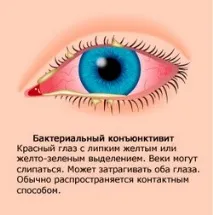 Бактеріальний кон’юнктивіт лікування та симптоми бактеріальний