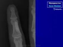 КСС. Мелореостоз. + мелореостозу