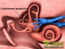 меньєра