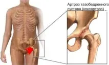 Що таке коксартроз і як його лікувати таке