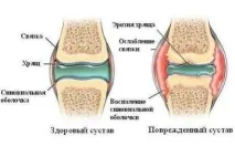 Що таке коксартроз і як його лікувати таке