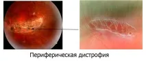 какво дегенерацията