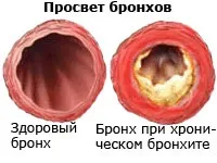 Чи справді ефективні банки при бронхіті ефективні