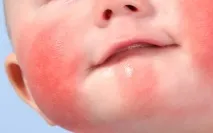 диатеза алергология