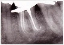 Dental-Revue, Статьи, Терапевтична, Пломбирование системы корневых каналов центрированной dental-revue