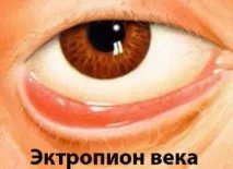 горния клепач причини