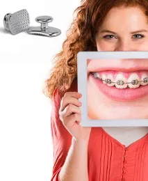 Фіксація ортодонтичної кнопки, студія Andreeva PearlSmile ортодонтичної