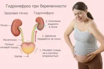 Гідронефроз при вагітності причини, симптоми, лікування, ризики причини