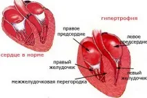 хипертрофия методи