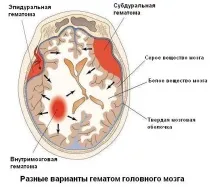 Гематома на голові після забиття що це лікування гематома