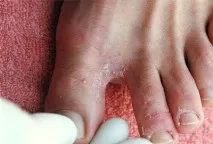 Pastile antifungice pentru ciuperca piciorului