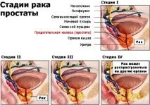 Рак передміхурової залози прогноз виживання раку