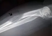 кісткової