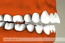 Виправлення прикусу без брекетів у дорослих та дітей види, причини та ознаки неправильного прикусу дітей