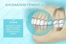 Виправлення прикусу без брекетів у дорослих та дітей види, причини та ознаки неправильного прикусу прикусу