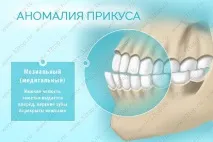 Виправлення прикусу без брекетів у дорослих та дітей види, причини та ознаки неправильного прикусу брекетів