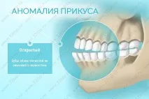 Виправлення прикусу без брекетів у дорослих та дітей види, причини та ознаки неправильного прикусу брекетів