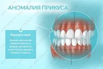 Виправлення прикусу без брекетів у дорослих та дітей види, причини та ознаки неправильного прикусу брекетів