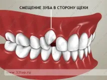 Виправлення прикусу без брекетів у дорослих та дітей види, причини та ознаки неправильного прикусу дорослих