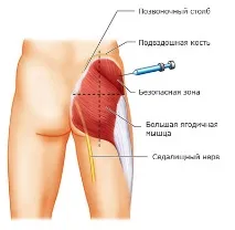 Як колоти анаболічні стероїди анаболічні