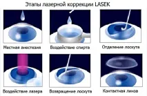 Як відновити та покращити зір при короткозорості – методи та способи виправлення відновити