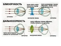 Як відновити та покращити зір при короткозорості – методи та способи виправлення методи
