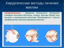 Як відновити та покращити зір при короткозорості – методи та способи виправлення короткозорості