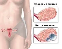 Як вилікувати кісту яєчника без операції кісту