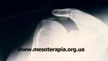 терапевтична мезотерапия