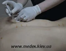 мезотерапия терапевтична