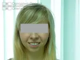 Комплексне виправлення прикусу за участю ортодонта та щелепно-лицьового хірурга – Катерина П, 23 г участю